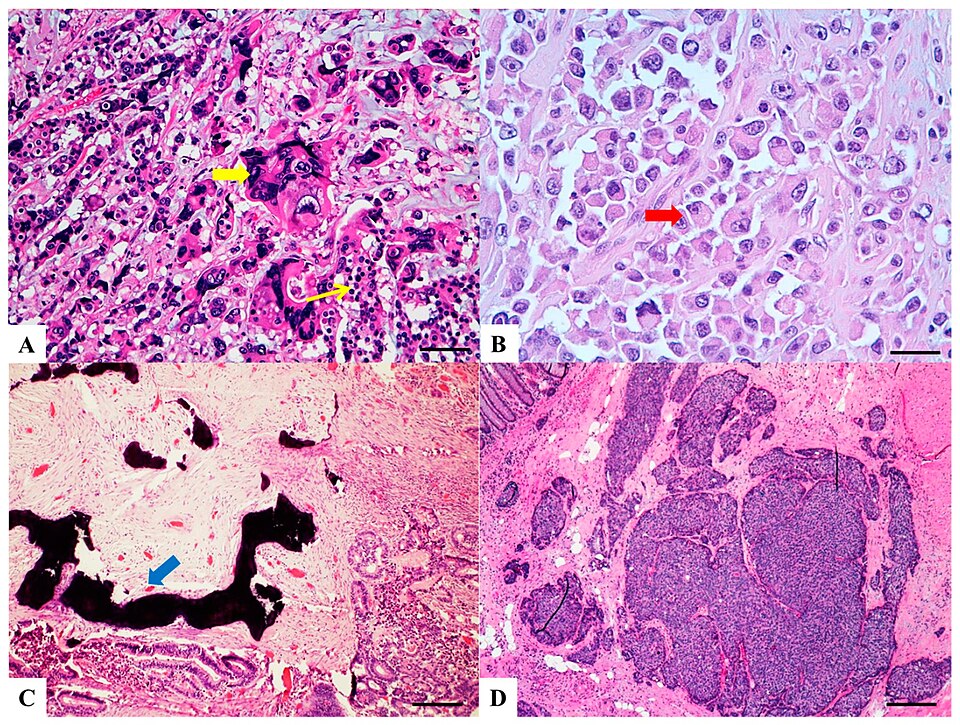 Only Colorectal Cancer Carries a Distinct Microbial "Fingerprint," Study Finds