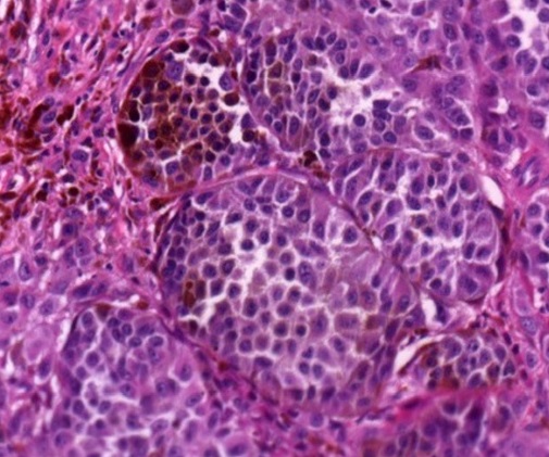 Melanoma Cases Expected to Surge Worldwide by 2040, New Study Warns