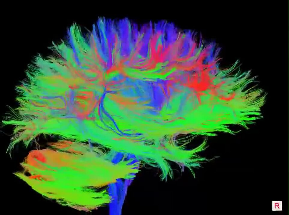 "Webs'r'us
Why we are the way we are: the Internet of our brains.
These are axonal nerve fibers in the real brain as determined by the measured anisotropy (directionality) of water molecules inside them. 3T 30 channel GRAPPA DTI scan protocol, deterministic tractography performed using TrackVis/FACT