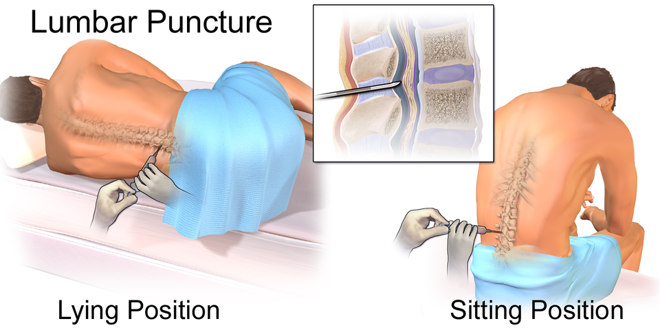 Lumbar Puncture.  See a related animation of this medical topic.