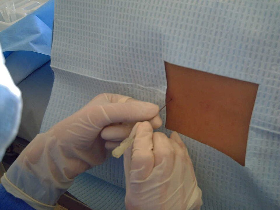 Médico realizando procedimiento de punción lumbar en un paciente en decúbito lateral derecho con hiperflexión de la columna lumbar