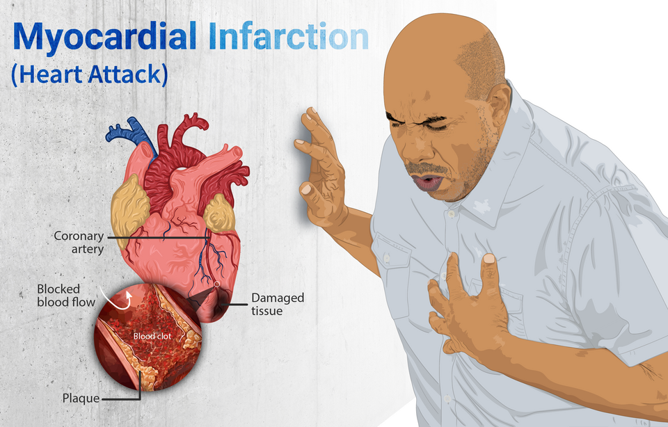 Depiction of a person suffering from a heart attack (Myocardial Infarction). Blood clot in the artery leading to the artery, along with chest pain - the primary symptom - has been shown.