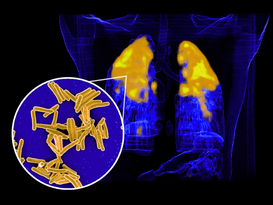 Scanning electron micrograph of Mycobacterium tuberculosis  bacteria, which cause TB (circular foreground image; virus is colorized gold) and a PET/CT scan showing TB infection (gold and yellow) in a patient’s lungs (background image).  Images courtesy of Clifton Barry III, Ph.D., Chief, Tuberculosi