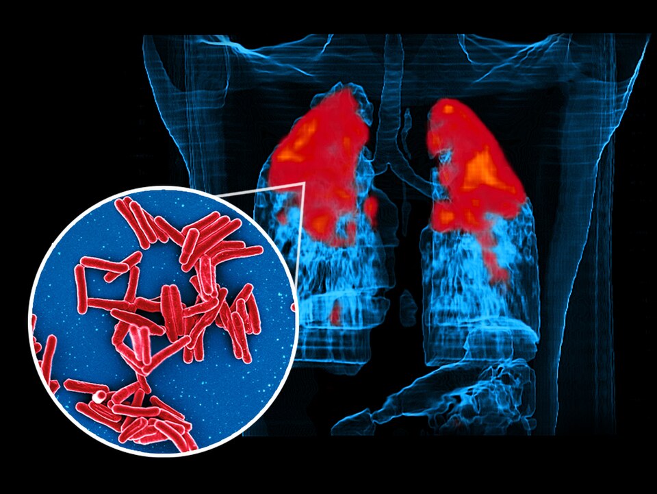 Scanning electron micrograph of Mycobacterium tuberculosis  bacteria, which cause TB (circular foreground image; virus is colorized red) and a PET/CT scan showing TB infection (red) in a patient’s lungs (background image).  Images courtesy of Clifton Barry III, Ph.D., Chief, Tuberculosis Research Se