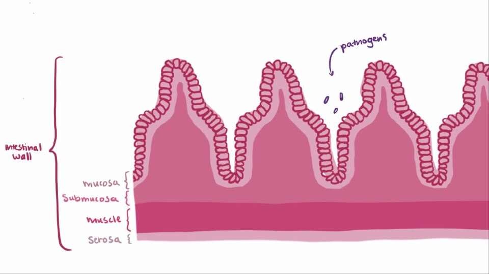 What is Crohn's disease (Crohn disease)? Crohn disease is a type of inflammatory bowel disease that damages the epithelial lining of the gastrointestinal tract. Crohn disease is thought to be an immune system-related and genetic in origin. This video describes the known pathophysiology, as well as c
