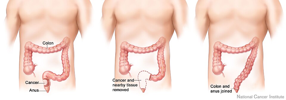 Anastomose de colon - cancer du colon
Source: http://visualsonline.cancer.gov/