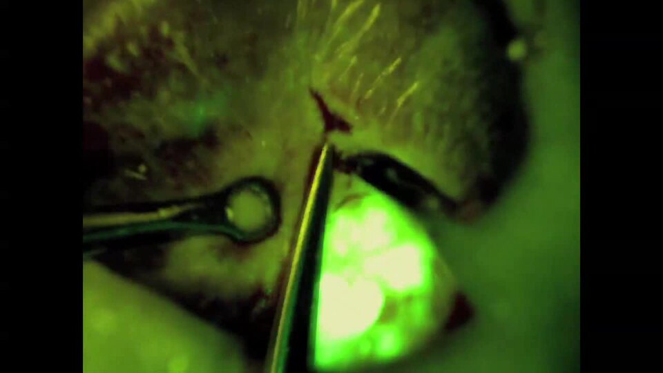 OBP-401 based-FGS of liver metastasis. Procedure for OBP-401-FGS with the Dino-Lite hand-held fluorescence-scope.