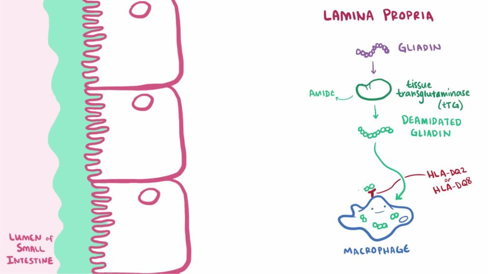 What is Celiac disease? Celiac disease, sometimes called celiac sprue, is a condition where the immune system reacts to gliadin, a component of gluten, which is found in a variety of grains like wheat, barley, and rye. This video covers the known pathophysiology, as well as important clinical signs