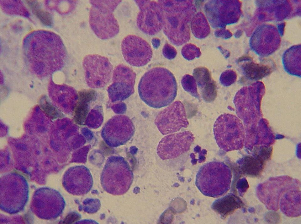 Cytology from a needle aspiration biopsy of a lymph node of a dog with lymphoma. The predominant cells are lymphoblasts. Slide was stained with a modified Wright's stain.