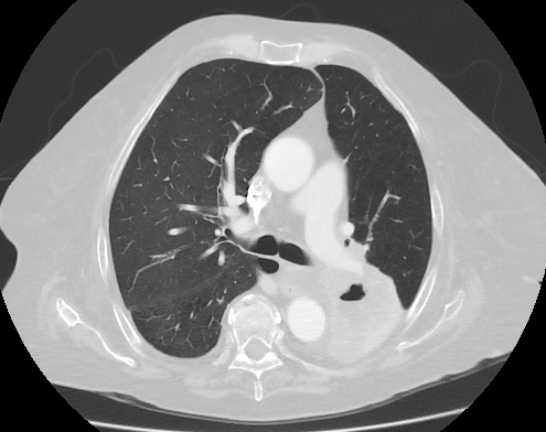 Cavitation of a lung squamous carcinoma, infrahilar, affecting the left lower lobe. 72 year old woman.