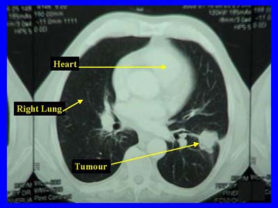 A CT scan of limited-stage small cell lung carcinoma