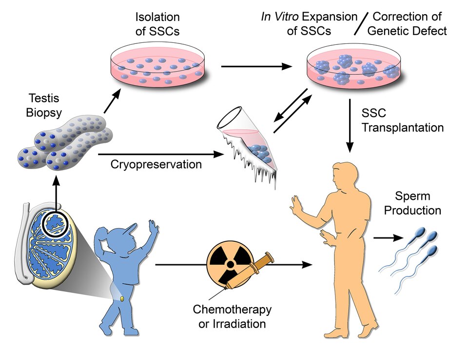 Diagram depicting male germline stem cell transplantation. The proposed clinical application of human spermatogonial stem cells (SSCs). Before treatment for cancer by chemotherapy or irradiation, a prepubertal boy could undergo a testicular biopsy to recover SSCs. The SSCs would be cryopreserved and