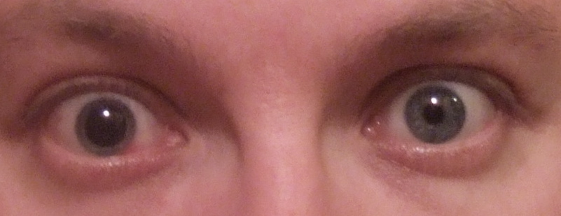 Eye treated with dilating eye drops (Atropine).