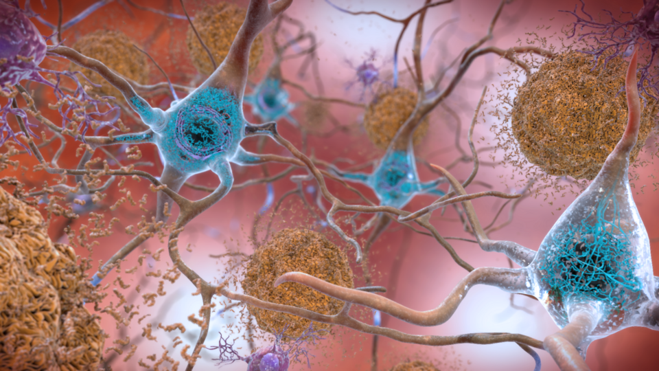 In the Alzheimer’s affected brain, abnormal levels of the beta-amyloid protein clump together to form plaques (seen in brown) that collect between neurons and disrupt cell function. Abnormal collections of the tau protein accumulate and form tangles (seen in blue) within neurons, harming synaptic co