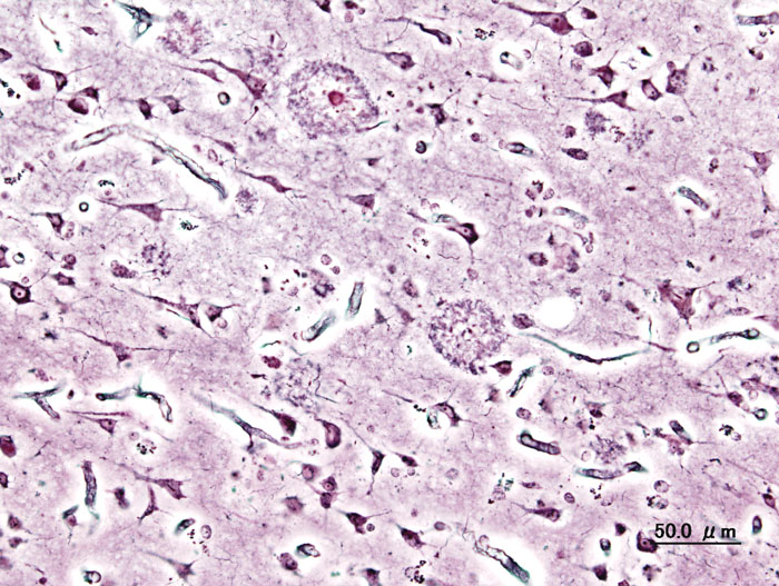 Histopathogic image of senile plaques seen in the cerebral cortex in a patient with Alzheimer disease of presenile onset. Silver impregnation. The same case as shown in a file "Alzheimer_dementia_(1)_presenile_onset.jpg".