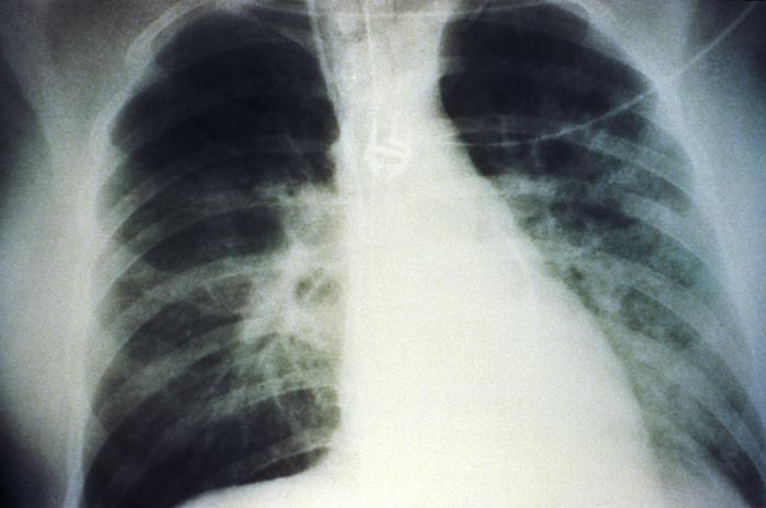 This AP chest x-ray reveals the mid-staged bilateral pulmonary effusion due to hantavirus pulmonary syndrome, or HPS.The radiological evolution of HPS begins with minimal changes of interstitial pulmonary edema, progressing to alveolar edema with severe bilateral involvement. Pleural effusions are
