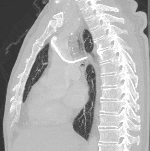 New Drug Cuts Pancreatic Cancer Death Risk by 60 Percent