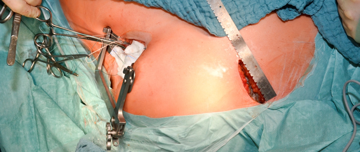 Minimal-invasive LVAD Implantation