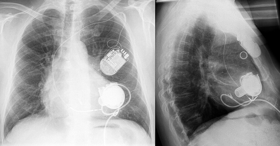 Röntgenbild des Thorax mit implantiertem links ventrikulärem Assistenz-Implantat (LVAD). Zusätzlich ist noch eine ICD vorhanden.
