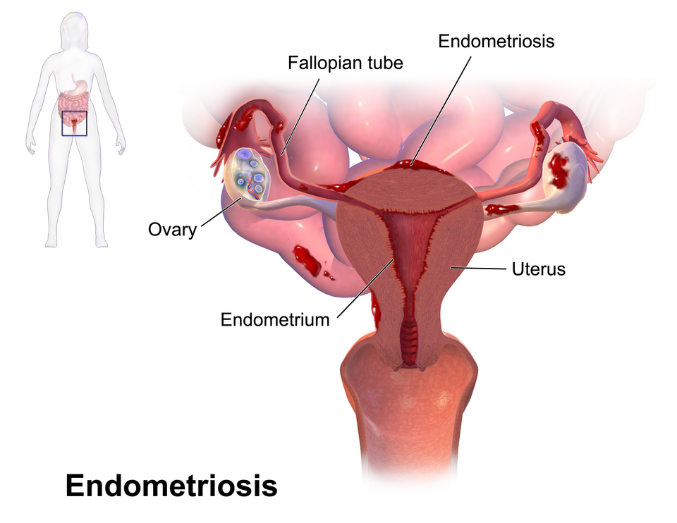 Endometriosis.  See a full animation of this medical topic.