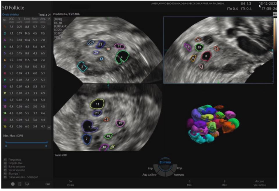 Ultrasound scans and 3D rendering of polycystic ovaries