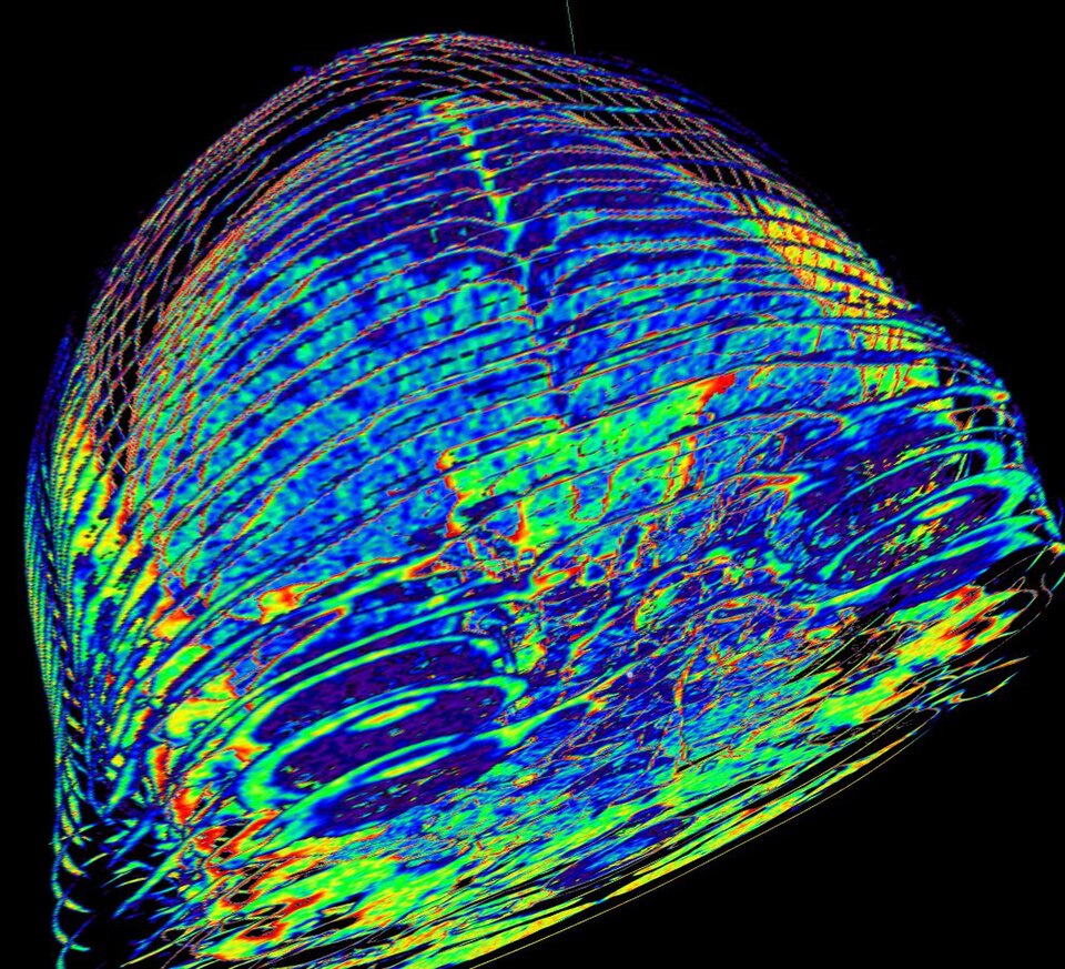 Migraine With Aura Raises Stroke Risk in Middle Age, Study Finds