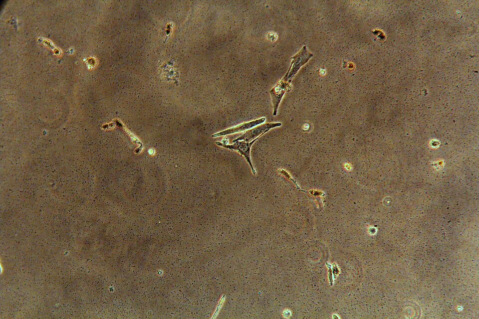 Skin cancer cells in laboratory in UFV, Viçosa, Brazil. Image made with inverted microscope. Mus musculus B16F10 skin melanoma.