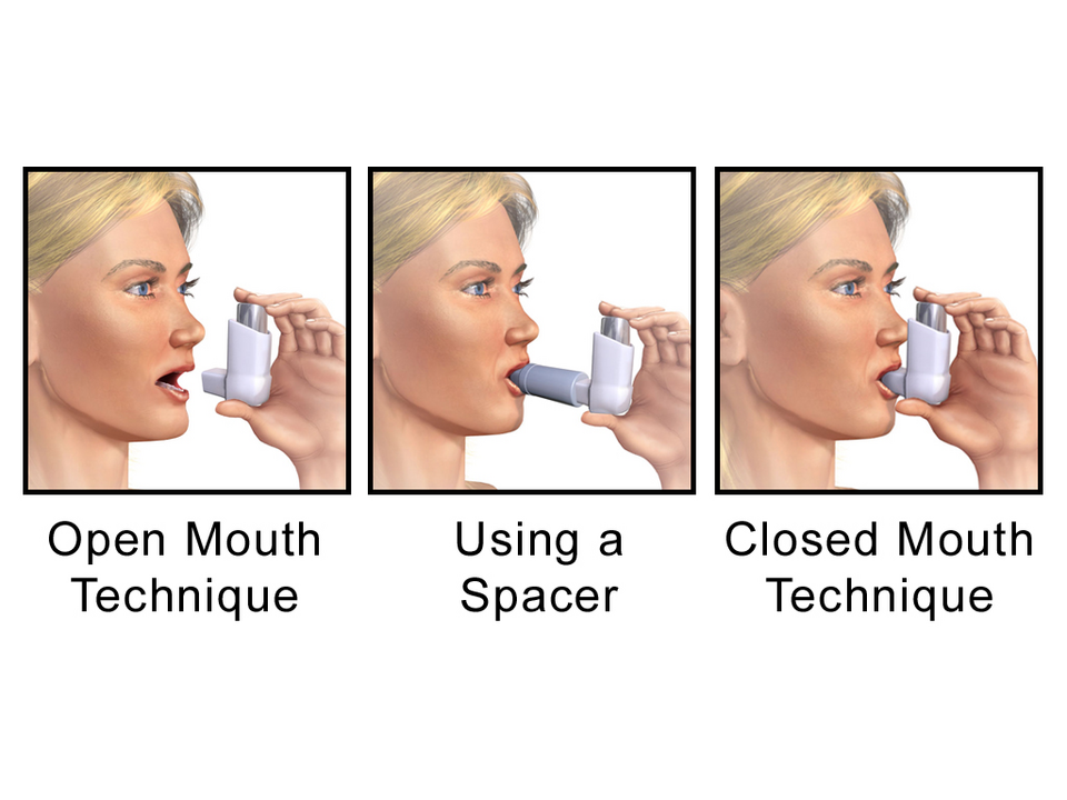 A medical illustration depicting a metered-dose inhaler for adults.