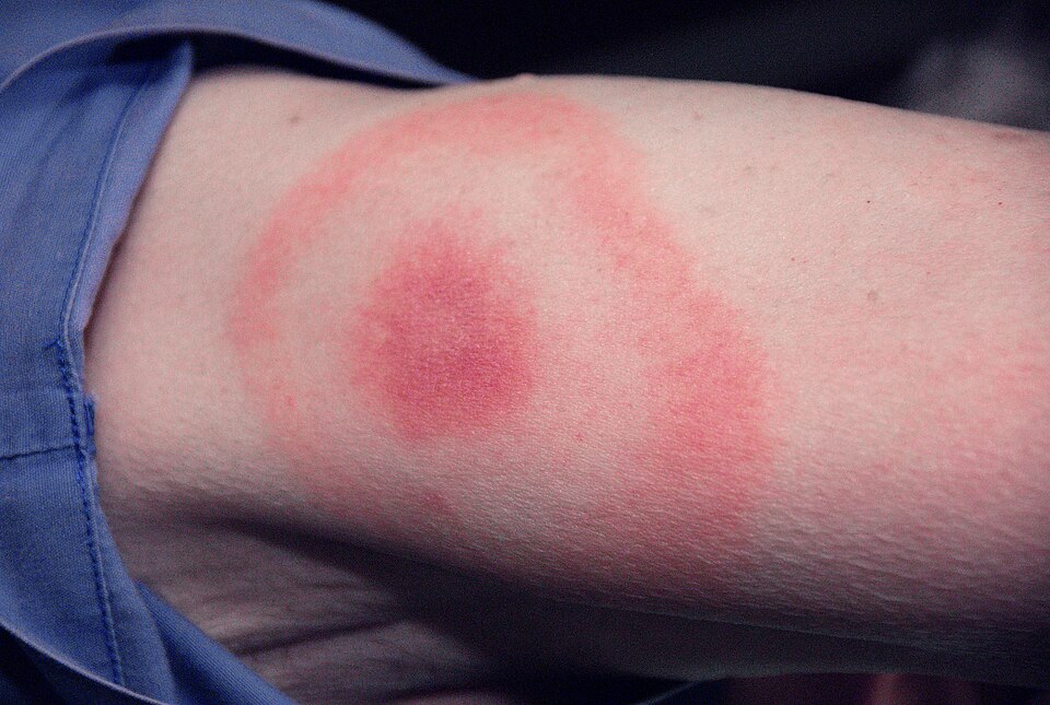The pathognomonic erythematous rash in the pattern of a bull’s-eye (erythema migrans). The rash manifested at the site of a tick bite, on this Maryland woman’s posterior upper arm, signifying a case of Lyme disease, caused by the bacterium Borrelia burgdorferi, and transmitted to humans, by the bite