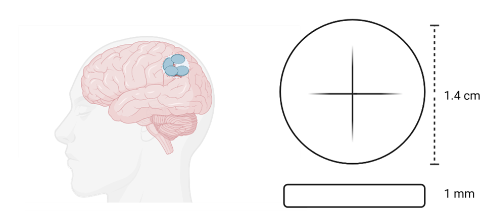 Gliadel wafers implanted in the resection cavity of the brain to treat for Glioblastoma. Gliadel wafers are 1.4 cm in diameter and 1 mm in thickness.