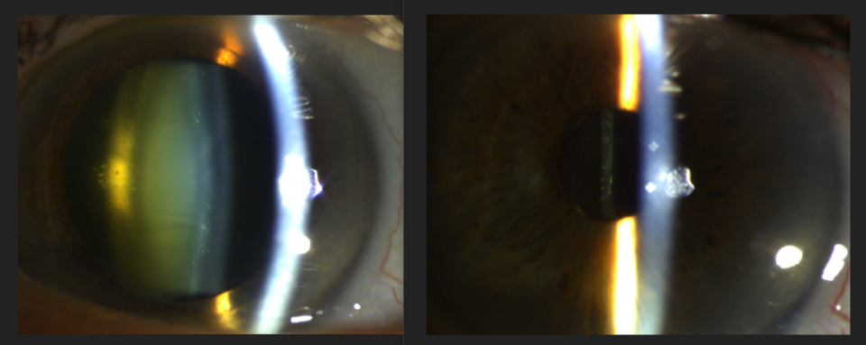 Slit lamp images of a cataract in a human eye before cataract surgery, accompanied by a slit lamp photo the same eye following cataract surgery with an intraocular lens (IOL) in the eye.