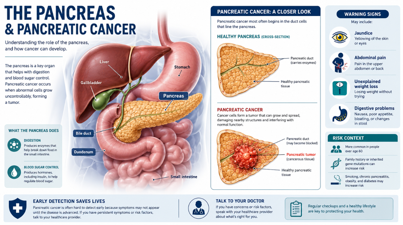 Medical infographic showing the pancreas, nearby digestive organs, and a comparison between a healthy pancreas and pancreatic cancer.