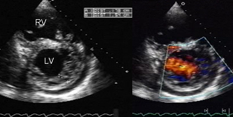 Two-dimensional parasternal and color Doppler images at the level of both ventricles that show the noncompacted:compacted wall ratio and how the color enters the intertrabecular recesses. LV: Left ventricle; LA: Left atrium; RV: Right ventricle; RA: Right atrium.