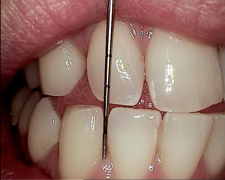 IntraOral Camera with Periodontal Pocket Probe