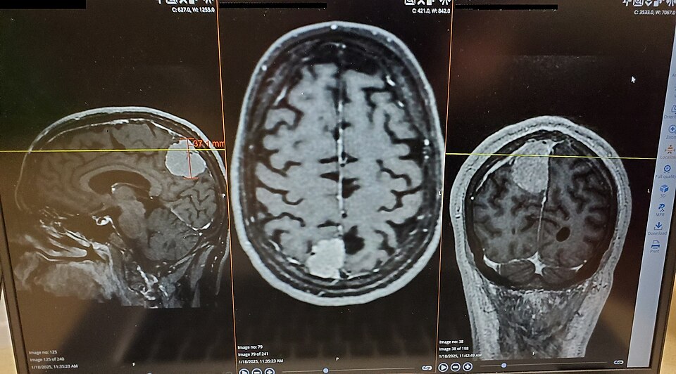 Brain Tumor MRI