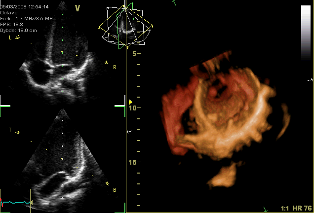 Global Health Experts Release New Standard Definition for Heart Failure