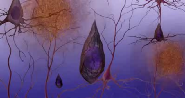 King's College Researchers Identify New Mechanism Behind Alzheimer's Brain Cell Death