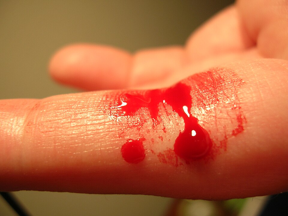 TRAUMAGEL Study Shows Hemorrhage Control Holds Without Rebleeding After Tourniquet Removal