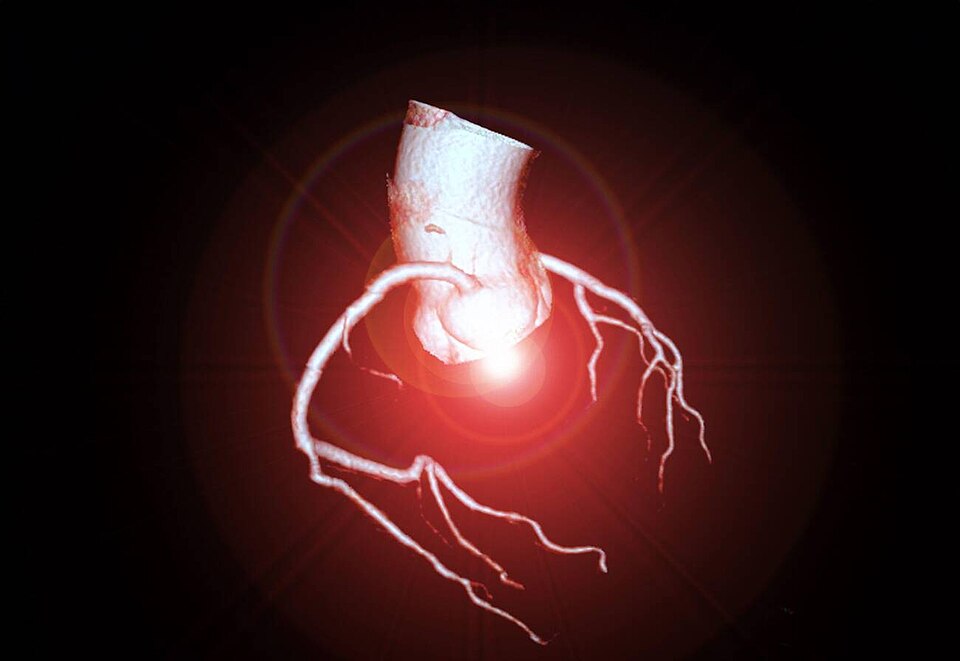CT Coronary Artery Imaging