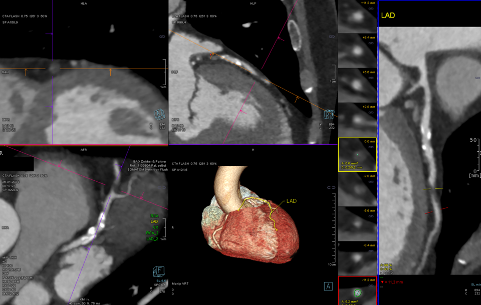 66y male. Siemens Somatom Flash. Topogram, CaSc sequence, test bolus sequence, FLASH 100 kV/345 mAs CTDIvol 3.37 mGy, total DLP = 225 mGycm. SyngoVia reconstruction.
