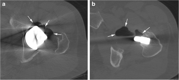 edit
Medical image of a 61-year-old male who presented to the emergency department with hip problems 43 months after having a titanium/titanium (Ti/Ti) modular neck-stem total hip arthroplasty (MTHA) (Wright Medical Systems, Arlington, Tennessee). It was diagnosed as aseptic hip pneumarthrosis. This
