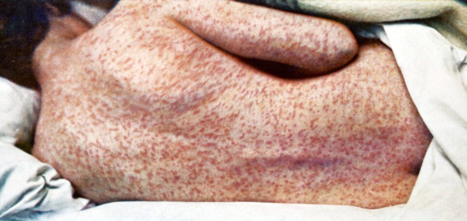 Wyoming Confirms Third Measles Case in Unvaccinated Adult This Year
