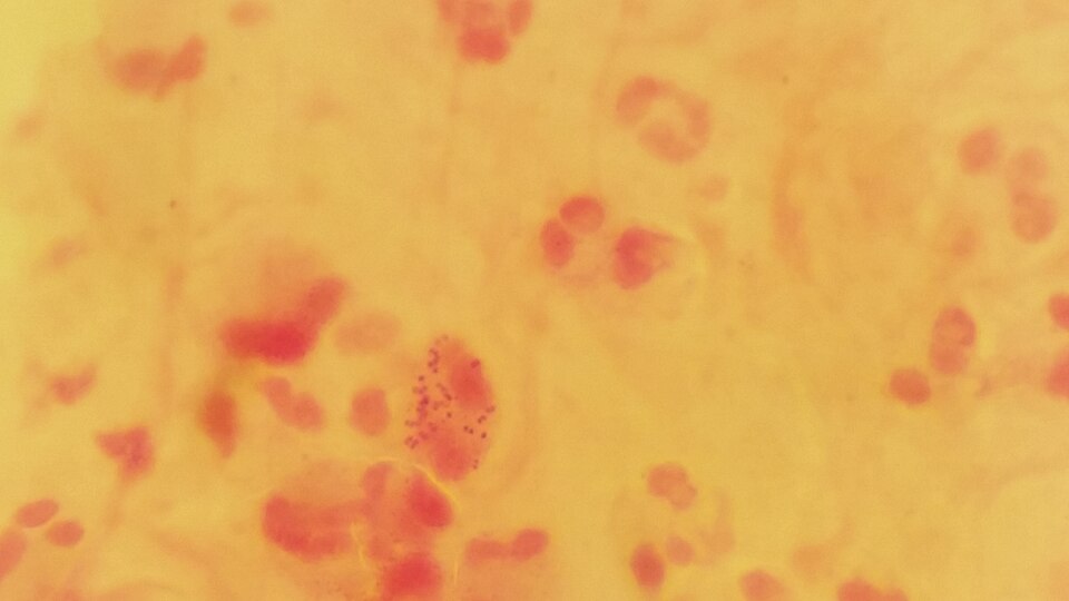 Scientists Discover How Gonorrhea Bacteria Constantly Outsmart the Immune System