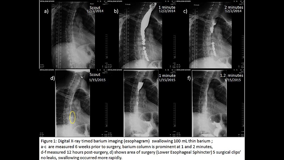 My goal in writing this is to provide information for others with Achalsia
My favorite medical image is a series of digital x-ray images of my esophagus.  I have had difficulty swallowing food (dysphagia) for about ten years. Occasionally, I'll get some food "stuck" in my esophagus and over the year