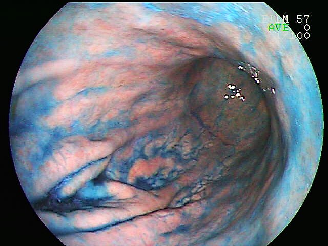 Indigo carmine staining(stmach), Upper gastrointestinal endoscopy, 72 y. o., male.
