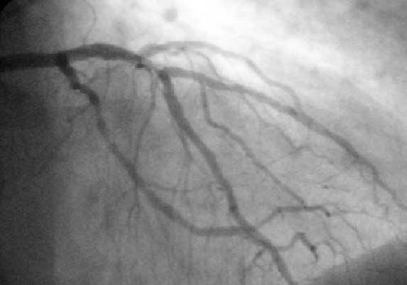 Coronary angiogram, showing the circulation in the left main coronary artery and its branches