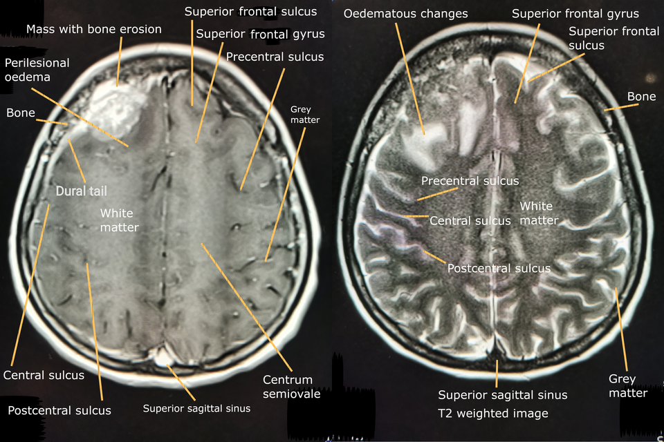 Hormonal Birth Control Linked to Higher Brain Tumor Risk in New Study
