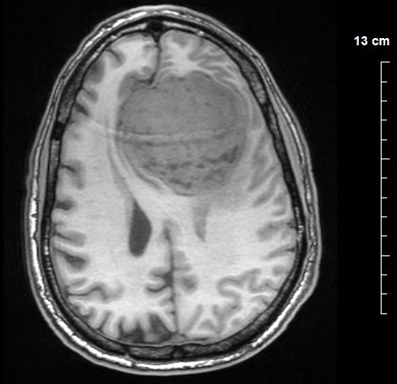 An MRI scan of a large meningioma tumour that took 8 hours to remove.