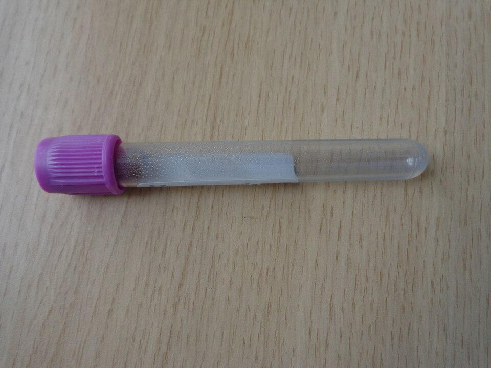 New Blood Test Shows Promise in Predicting Alzheimer's Symptom Onset