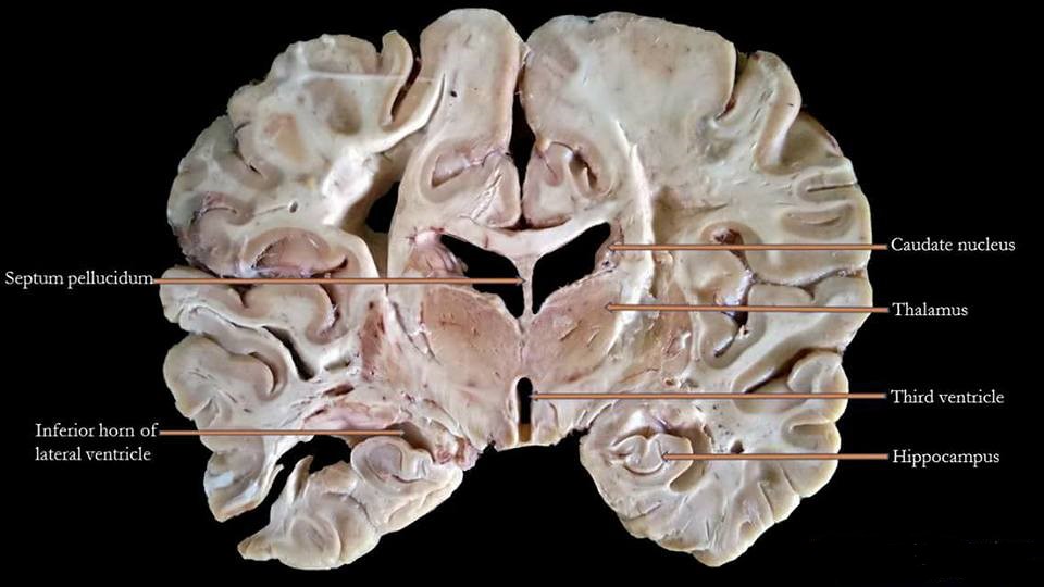 Cut section of human brain.